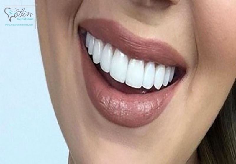 لمینت دندان چه کاربردی دارد؟